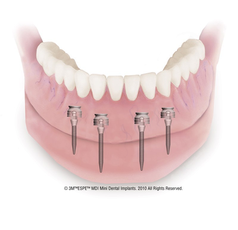 Mini Implantate Zahnimplantate Linz Traun Dr. med. dent. Dana Alexandru