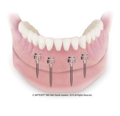 Mini Implantate Zahnimplantate Linz Traun Dr. med. dent. Dana Alexandru