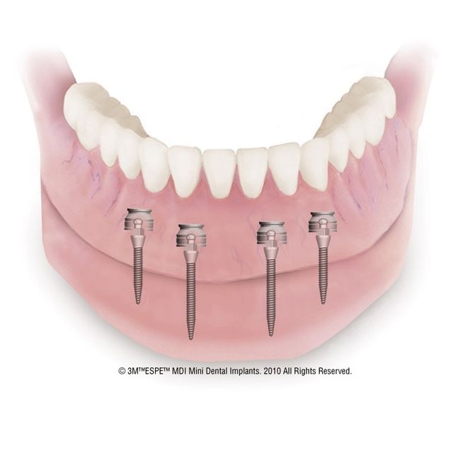 Mini Implantate Zahnimplantate Linz Traun Dr. med. dent. Dana Alexandru